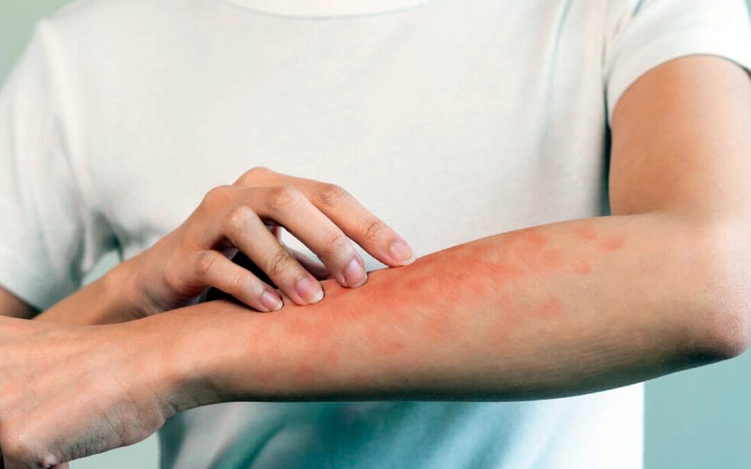 PSORIASIS REQUIERE DIAGNÓSTICO Y ATENCIÓN OPORTUNOS; ESTÁ LIGADA A OTROS PADECIMIENTOS