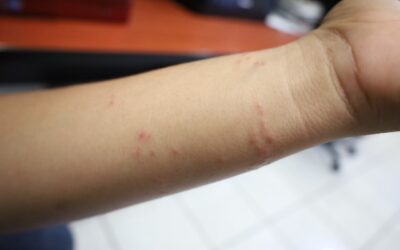 SALUD COLIMA EXHORTA A IDENTIFICAR FACTORES POR ALERGIA Y ACUDIR A RECIBIR ATENCIÓN MÉDICA GRATUITA